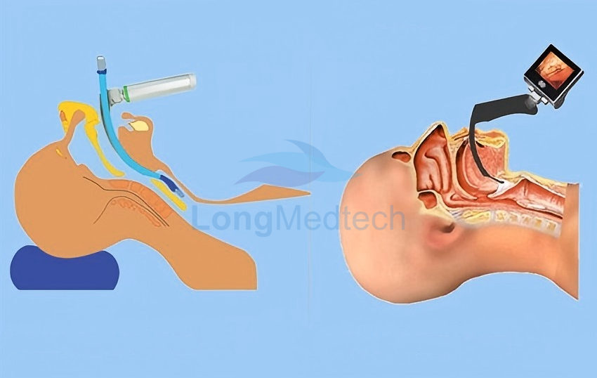 Por qu&eacute; son importantes los videolaringoscopios