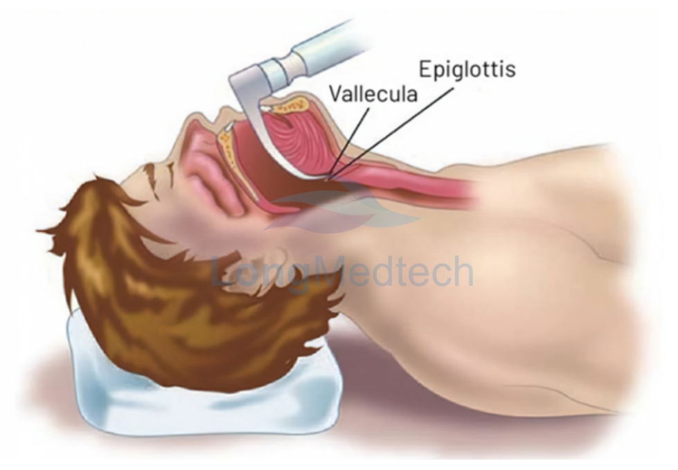 ما هو منظار الحنجرة بالفيديو